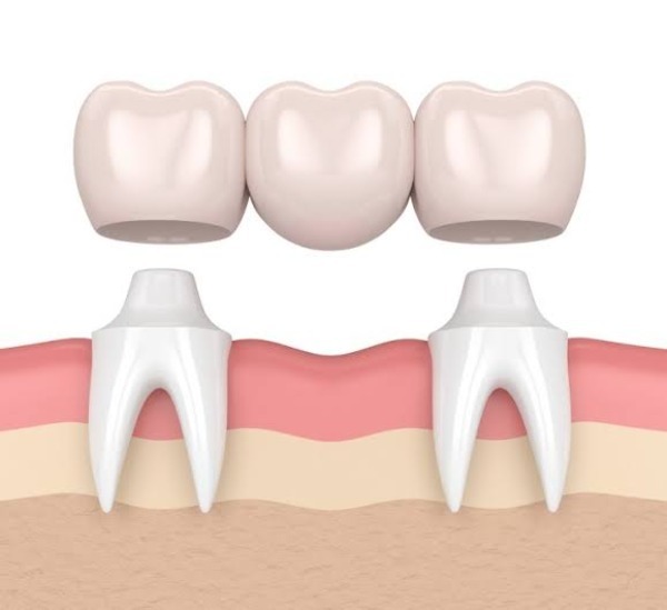 Nhổ răng bao lâu thì làm cầu răng được? Điều kiện và lưu ý cần biết