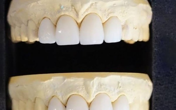 Khi nào cần gặp bác sĩ vì ê buốt sau khi dán veneer?