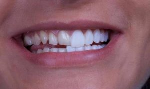 Dán sứ veneer có bị ê buốt không? Sự thật từ nha sĩ