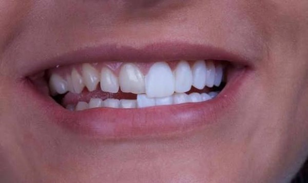 Dán sứ veneer có bị ê buốt không? Sự thật từ nha sĩ