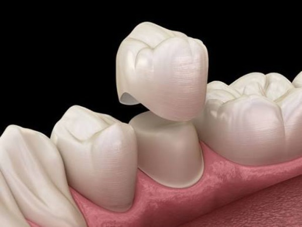 Thời điểm làm cầu răng sau khi nhổ răng cần được cân nhắc kỹ