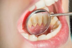 Cao răng màu đen có cạo sạch được không? Cách cạo và giá tiền