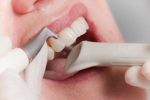 Cạo vôi bao lâu một lần là tối ưu?