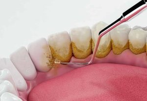 Cạo vôi răng xong bị ê buốt: Cách xử lý hiệu quả