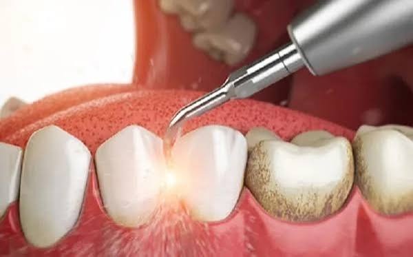 Cao răng màu đen là gì, bản chất và nguyên nhân hình thành?