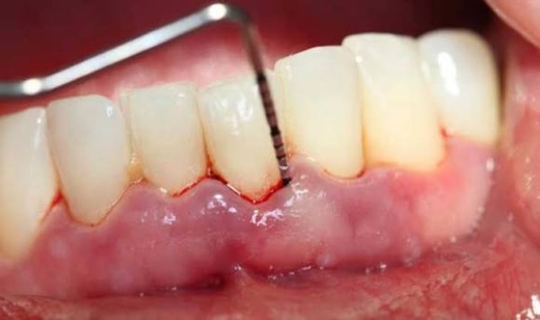 Cách xử lý sốt nhẹ tại nhà và khi nào gặp bác sĩ?