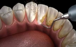 Người cao huyết áp có thể cạo vôi răng được không?