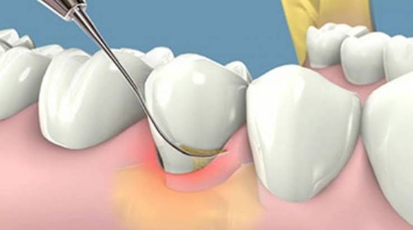 Sốt nhẹ sau cạo vôi răng: Khi nào cần lo, khi nào an toàn