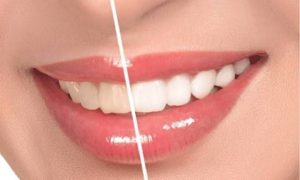 Tẩy trắng răng có hại không? Tất cả điều bạn cần biết