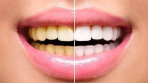 Tẩy trắng răng bị vàng lại: Cách khắc phục và phòng ngừa