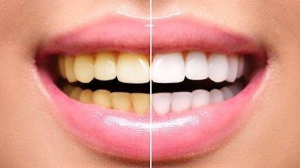Tẩy trắng răng bị vàng lại: Cách khắc phục và phòng ngừa