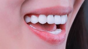 Tẩy trắng răng hoạt động thế nào?